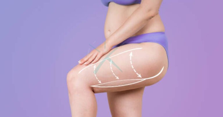 Does Thigh Liposuction Get Rid of Cellulite