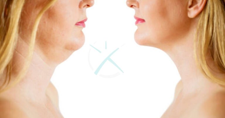 Elevate Elegance with Neck and Chin Liposuction in Dubai