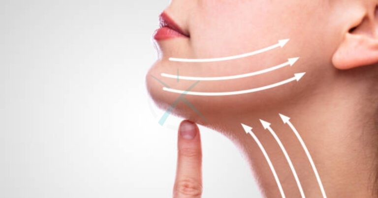 Is Neck Liposuction Safe A Comprehensive Guide