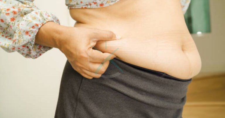 Lipedema and Liposuction Choosing the Best Approach