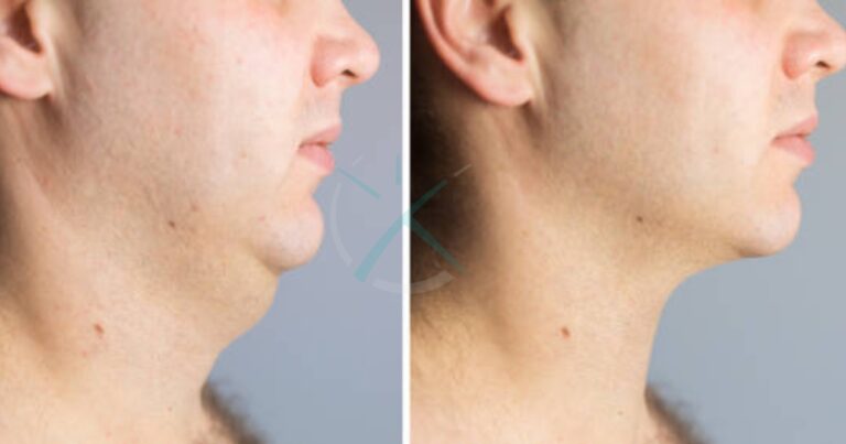 What are the Risks of Chin Liposuction