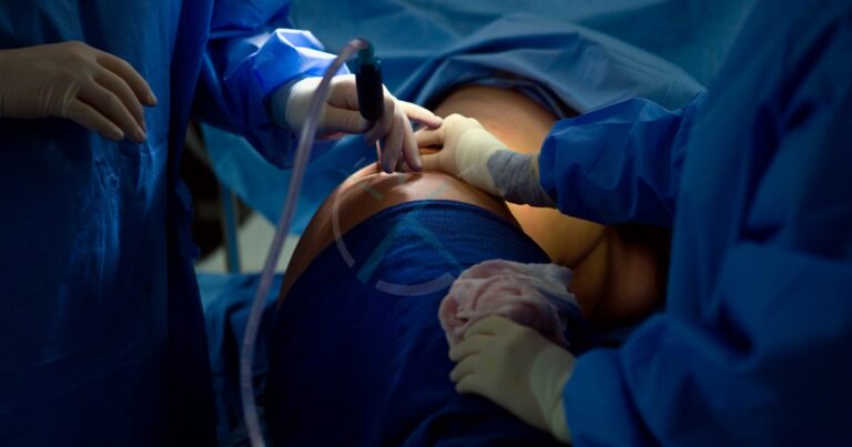 Liposuction Cost In Dubai