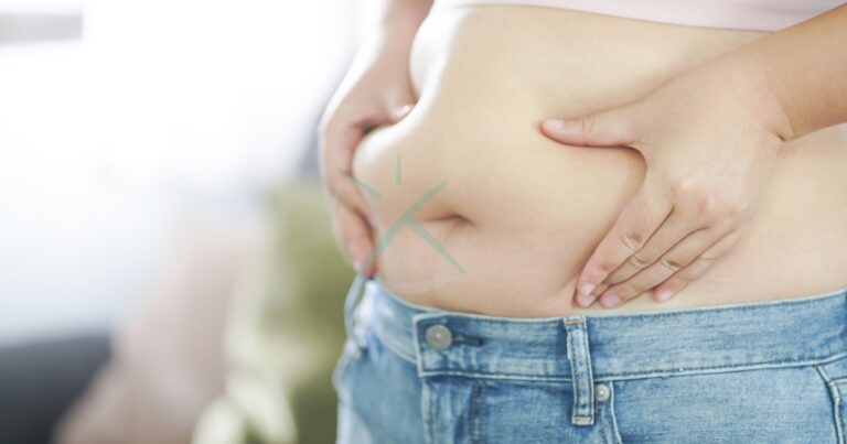 Liposuction As An Obesity Treatment: What You Should Understand